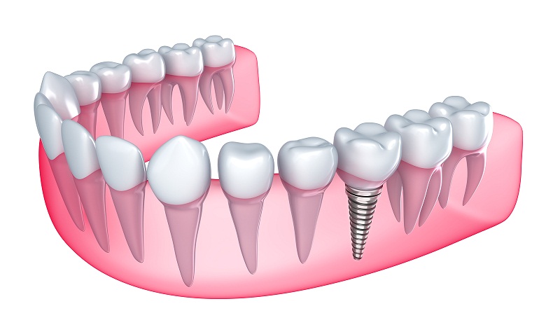 مزایا و معایب ایمپلنت یا کاشت دندان چیست؟