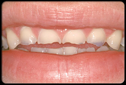 فرسایش و ساییدگی دندان