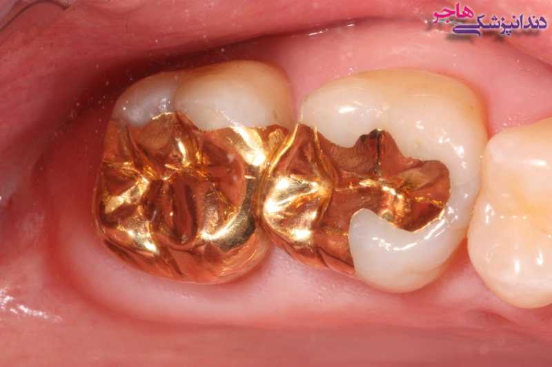 پر کردن دندان با استفاده از طلا