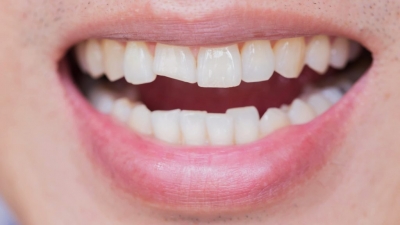 عوامل ایجاد خرد شدگی دندان و علل تشدید آن
