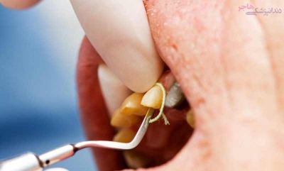 نخ زیر لثه ای چیست و در درمانهای دندانپزشکی چه کاربردی دارد؟