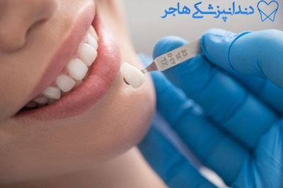 لمینت و کامپوزیت دندان در مرکز شهر | کلینیک دندانپزشکی هاجر