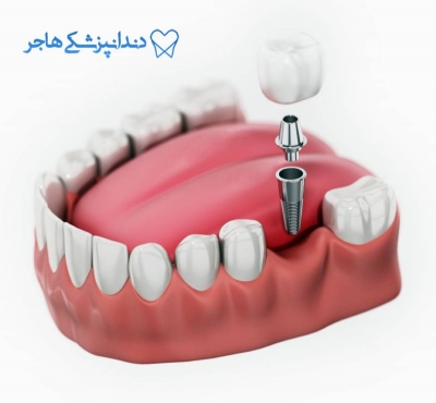 ایمپلنت تخصصی دندان در دندانپزشکی دکتر کیخا