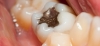 حساسیت دندان ها بعد از پر کردن