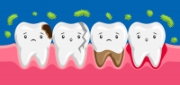 آبسه ی دندان چیست و چگونه بوجود می آید؟