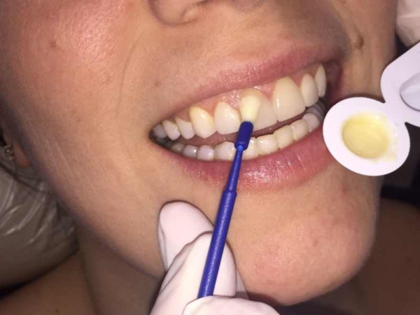 وارنیش فلوراید چه اثری بر روی دندان ها دارد و فواید آن برای دندان ها چیست؟