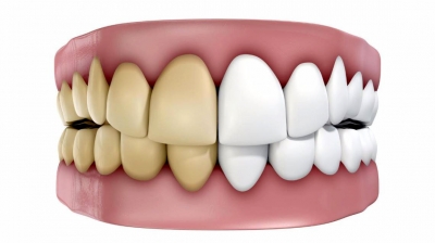 چه عواملی باعث زرد شدن دندانها میشوند