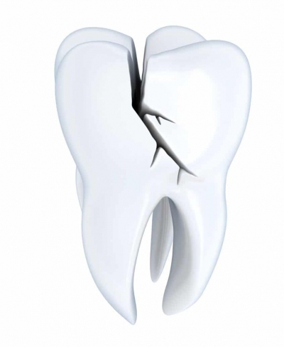 سندروم دندان کرک شده یا دندان ترک خورده چیست؟