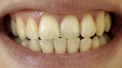 چه عواملی می تواند باعث تغییر رنگ دندان شود؟