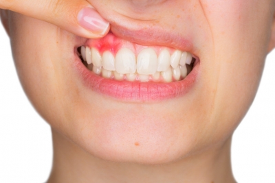 عفونت دندان و روش مقابله با آن