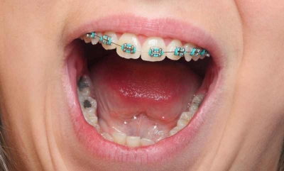 دوام پر کننده نقره چقدر است و دندان پر شده چه مدت سالم خواهند ماند؟