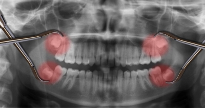 روش های خانگی برای رهایی از درد دندان عقل