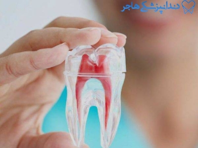کلینیک تخصصی عصب کشی دندان | مرکز تهران