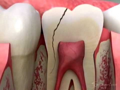 اگر دندانمان شکست چکار کنیم؟