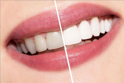 سفید کردن دندان یکی از راههای ایجاد لبخند هالیوودی