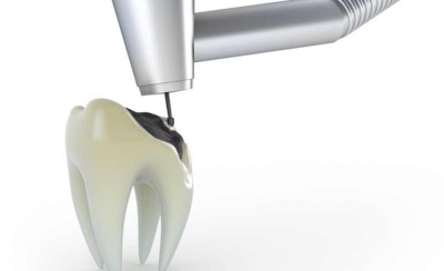 ترمیم دندان آسیب دیده به کمک بهترین روش های موجود در دندانپزشکی ترمیمی
