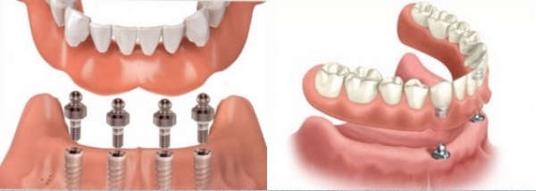 اوردنچر یا دندان مصنوعی بر پایه ایمپلنت