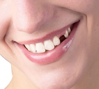 3 گزینه برای جایگزینی دندان های از دست رفته