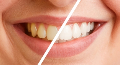 چگونه می توان دندانها را به طور طبیعی سفید کرد.