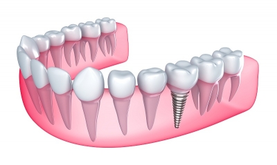 معایب و مزایای ایمپلنت یا کاشت دندان چیست؟