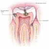 انواع درمان حفره های ایجاد شده در دندان