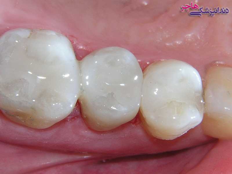 پر کردن دندان با کامپوزیت سفید
