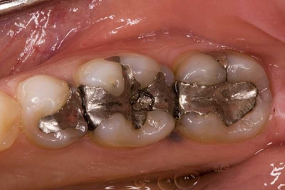 انواع پر کننده دندان دندان | معایب و مزایا