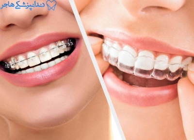 مراحلی که برای انجام ارتودنسی دندان باید طی کرد!