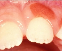 هر آنچه که باید در مورد لثه متورم در اطراف دندان بدانیم