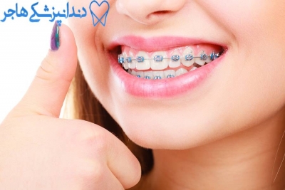 چه افرادی نیاز به ارتودنسی دندان دارند؟