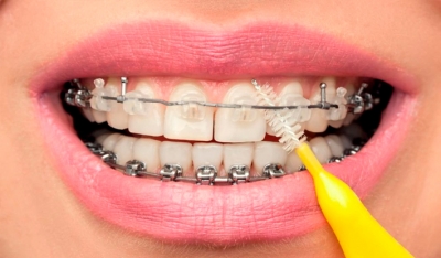 مراقبت از ارتودنسی دندان