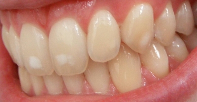 چه عواملی منجر به نامرتب شدن دندان ها می شود؟