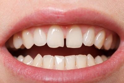 فاصله بین دندانها